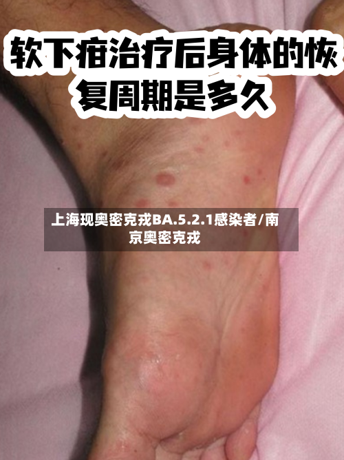 上海现奥密克戎BA.5.2.1感染者/南京奥密克戎-第3张图片